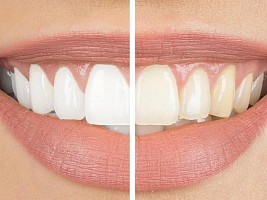 Отбеливание зубов: виды аппаратов и чем они отличаются